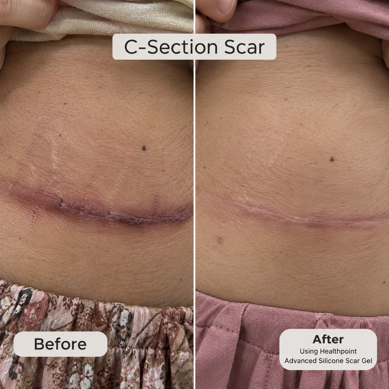 Customer-shared before and after photos of a C-section scar, using Health Point Advanced Silicone Scar Gel