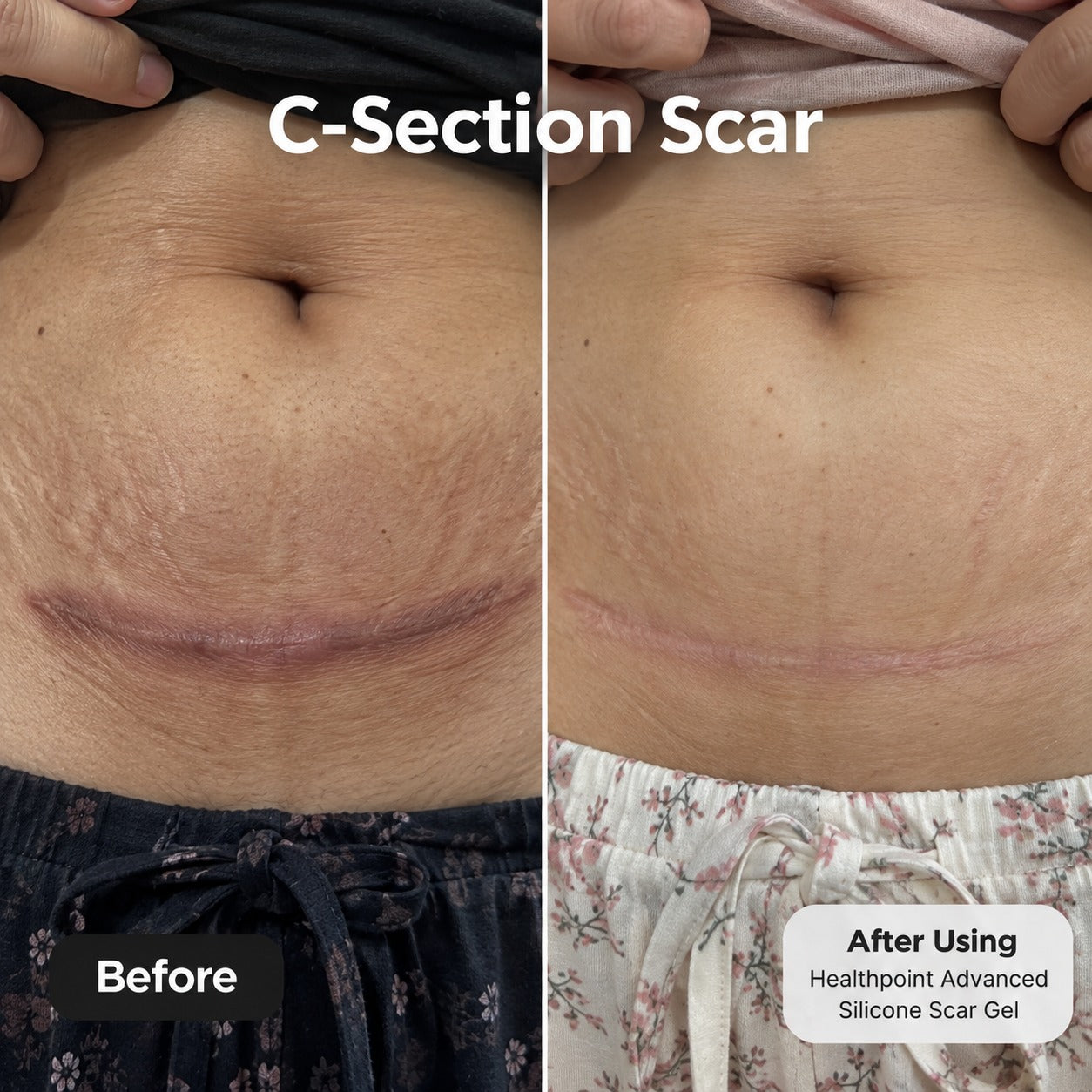 Customer-shared before and after photos of a C-section scar, using Health Point Advanced Silicone Scar Gel