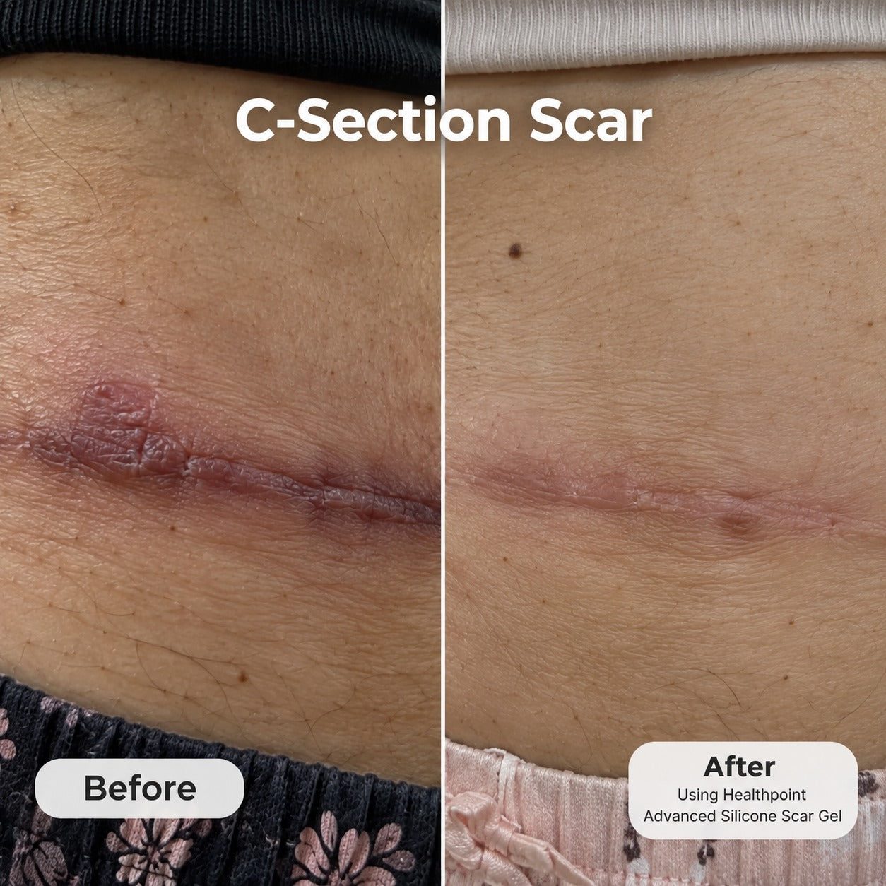 Customer-shared before and after photos of a C-section scar, using Health Point Advanced Silicone Scar Gel