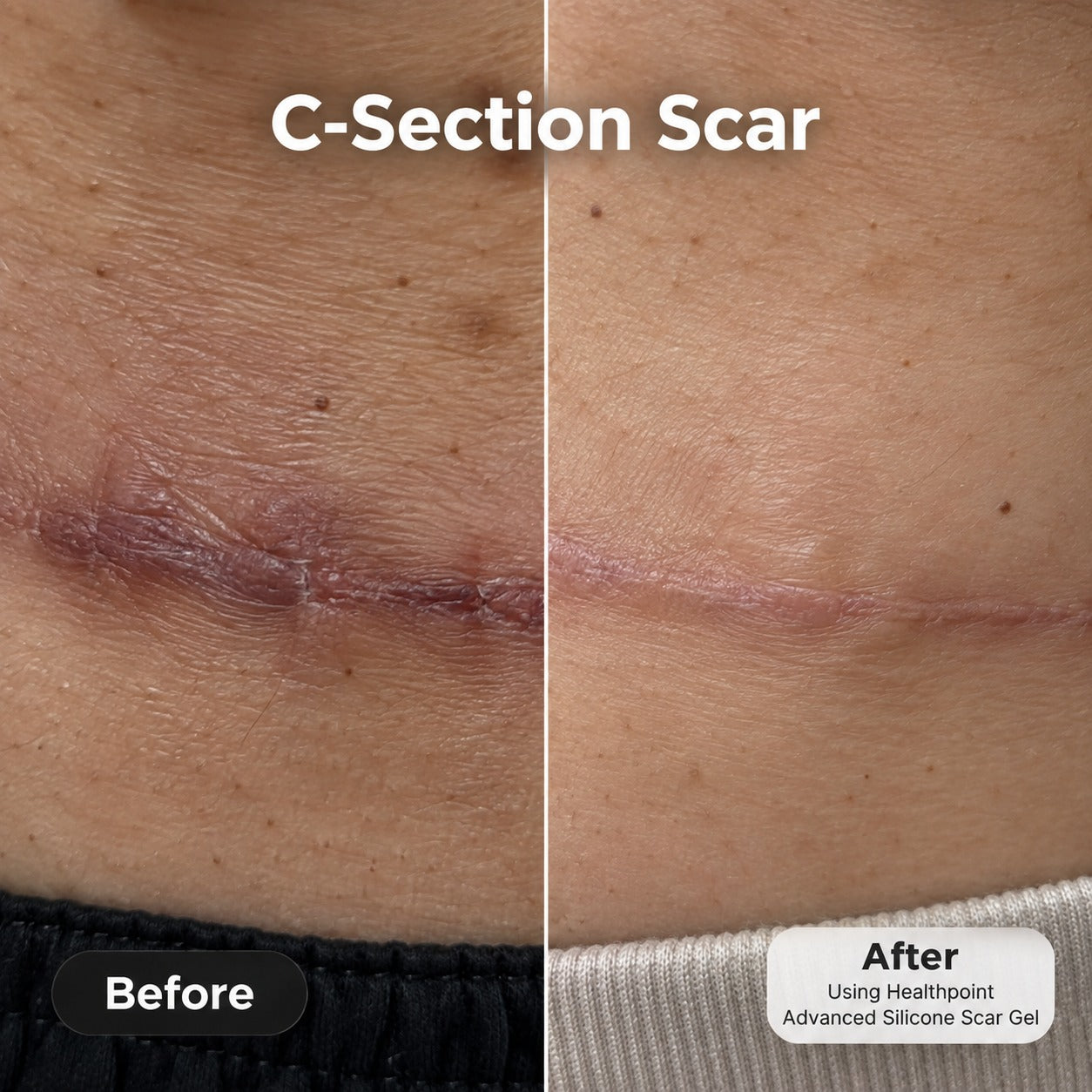 Customer-shared before and after photos of a C-section scar, using Health Point Advanced Silicone Scar Gel