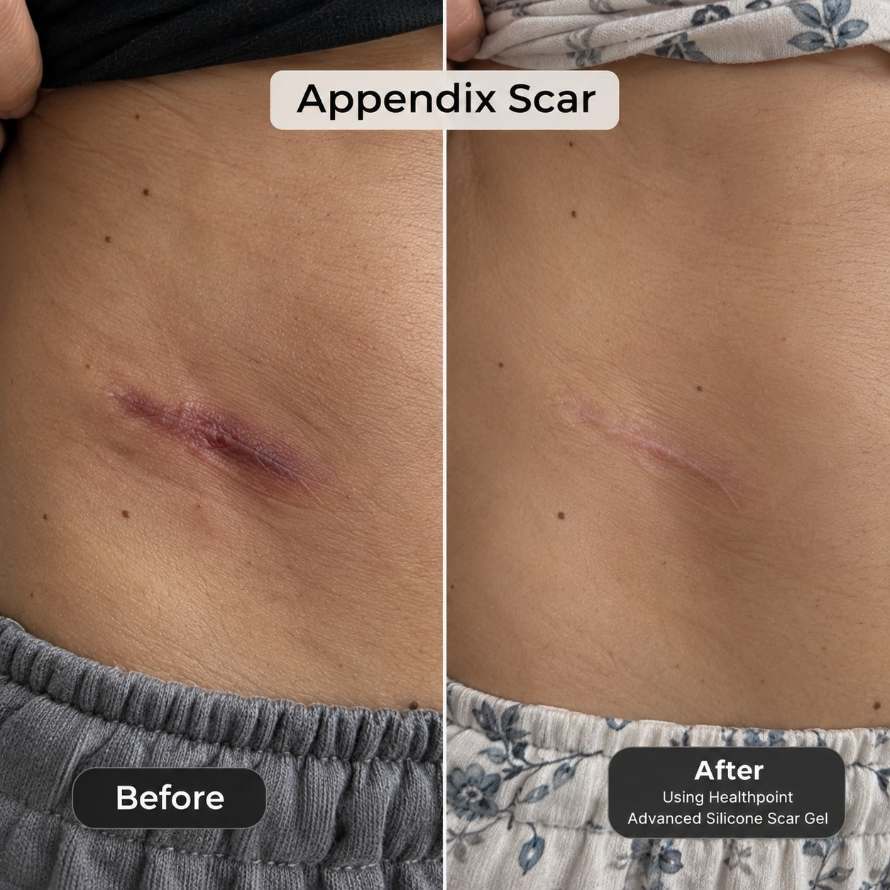 Customer-shared before and after photos of an appendix scar, using Health Point Advanced Silicone Scar Gel