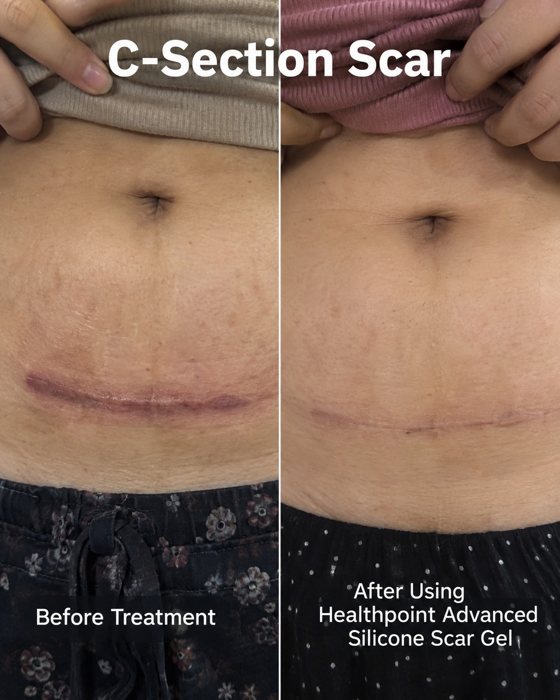 Customer-shared before and after photos of a C-section scar, using Health Point Advanced Silicone Scar Gel
