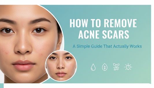 how to remove acne scars